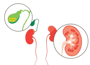 Kidney & gal bladde stones