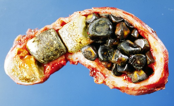 Homeopathy Treatment for Kidney & Gall Bladder Stones