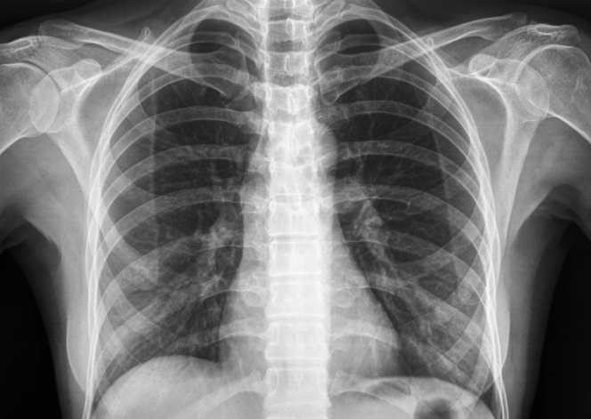 Treatment for Bronchitis