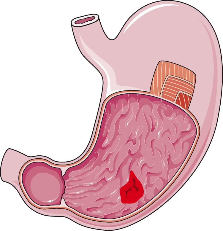 Homeopathy treatment for duodenal ulcers