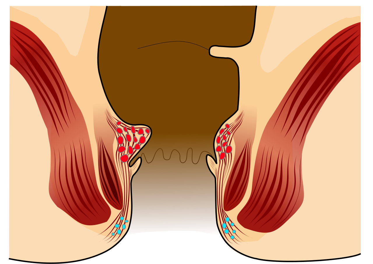 Homeopathy Treatment for piles