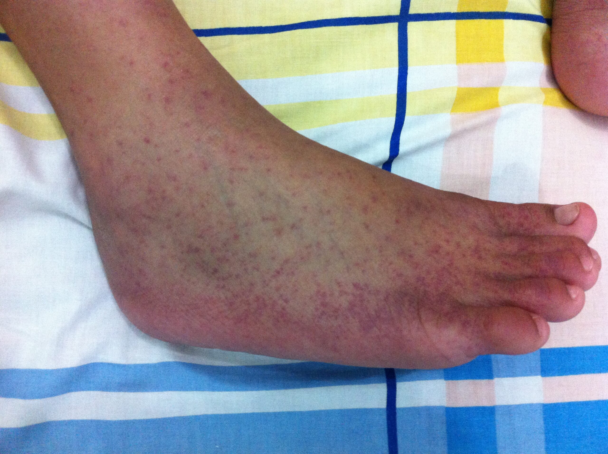 Homeopathy Treatment for Chikungunya
