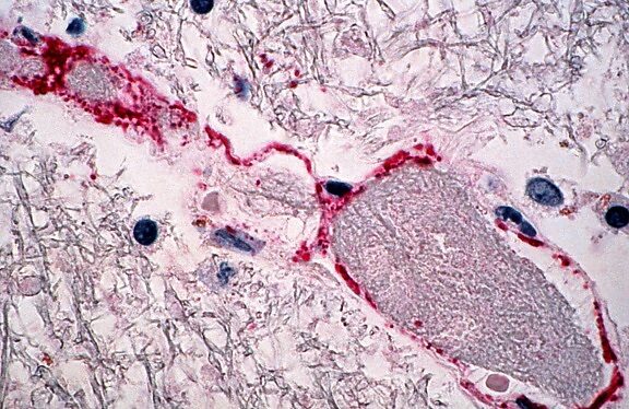 Homeopathy treatment for Inflammation