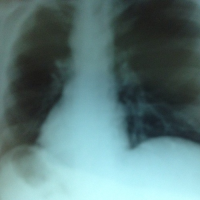 Treatment for Bronchitis