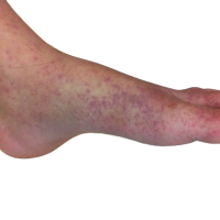 Chikungunya