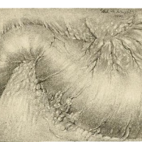 Duodenal ulcers