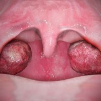 Homeopathy Treatment for Tonsillitis